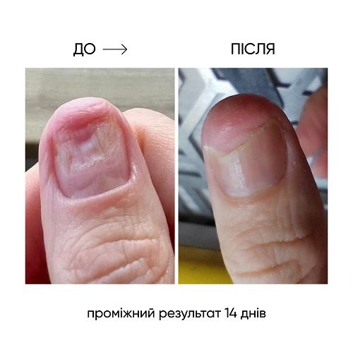 Регенеруюча олія проти оніхолізису NAILSOFTHEDAY ONISTOP  15мл